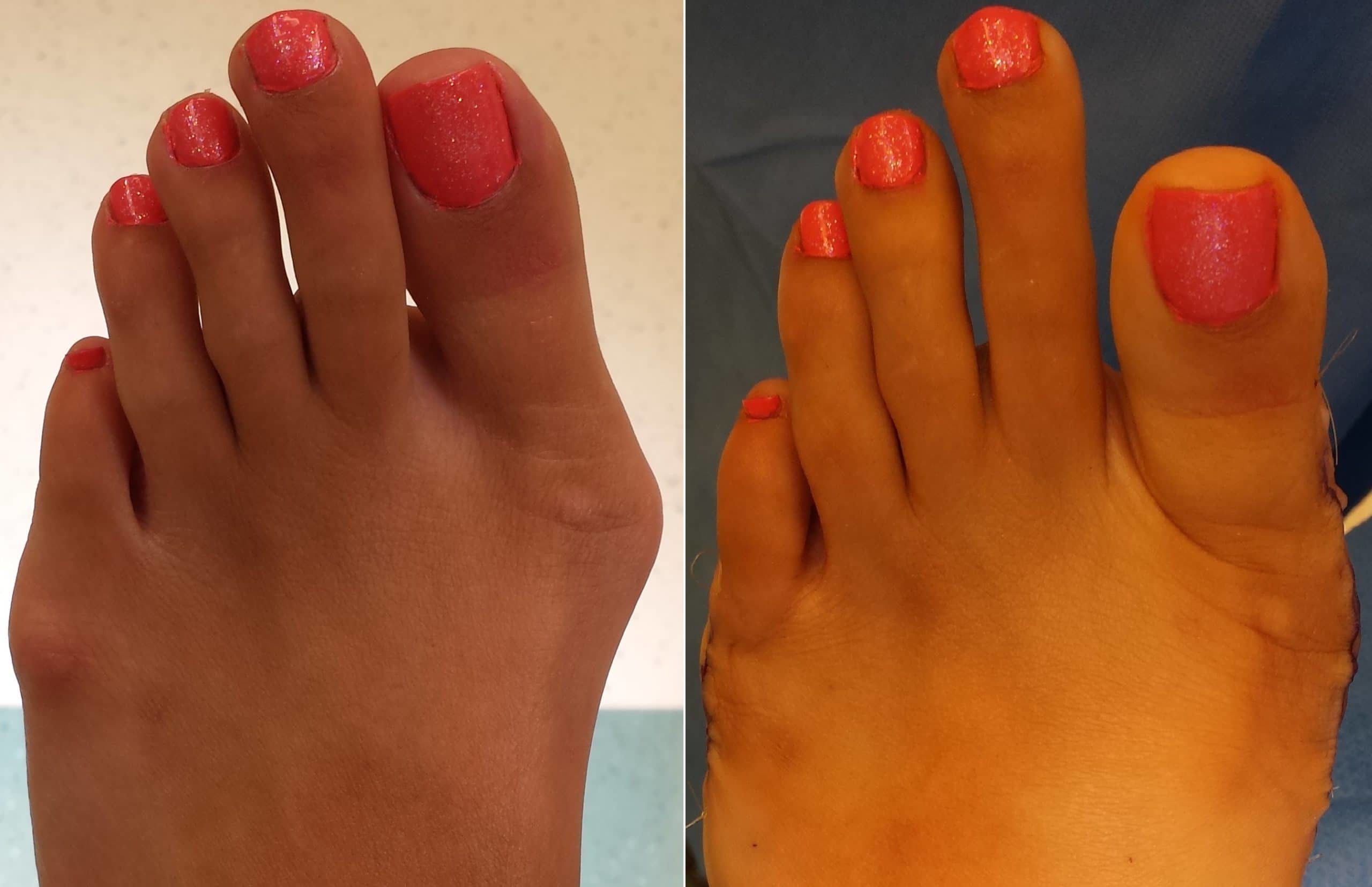 Bunions Before And After Surgery