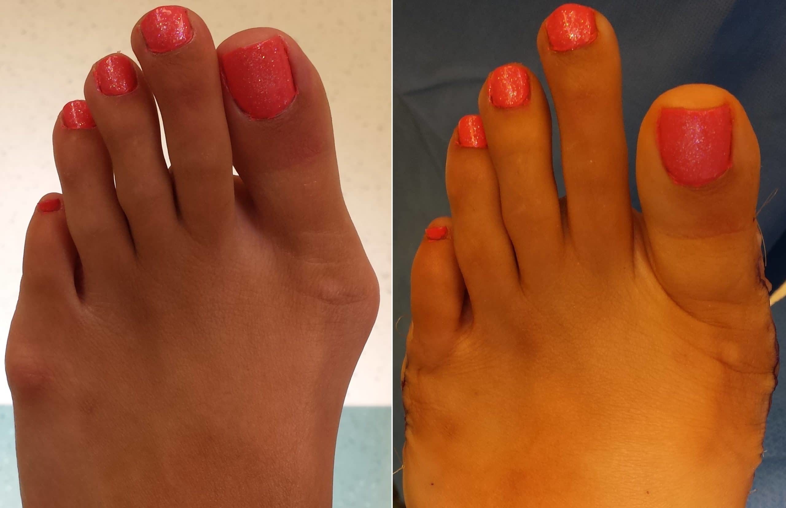 bunion-surgery-orange-county-irvine-southern-california