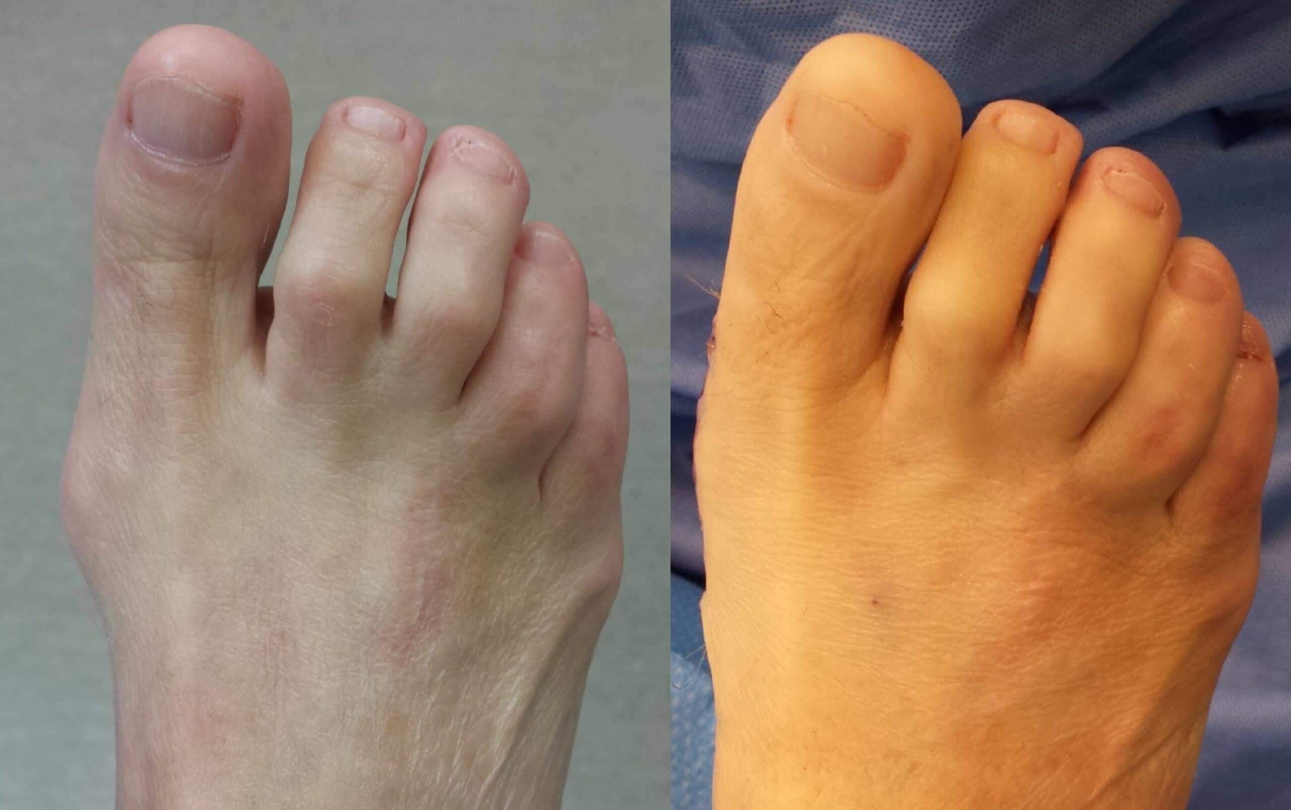 Repair Hammer Toe Without Surgery - Aiko Vancil