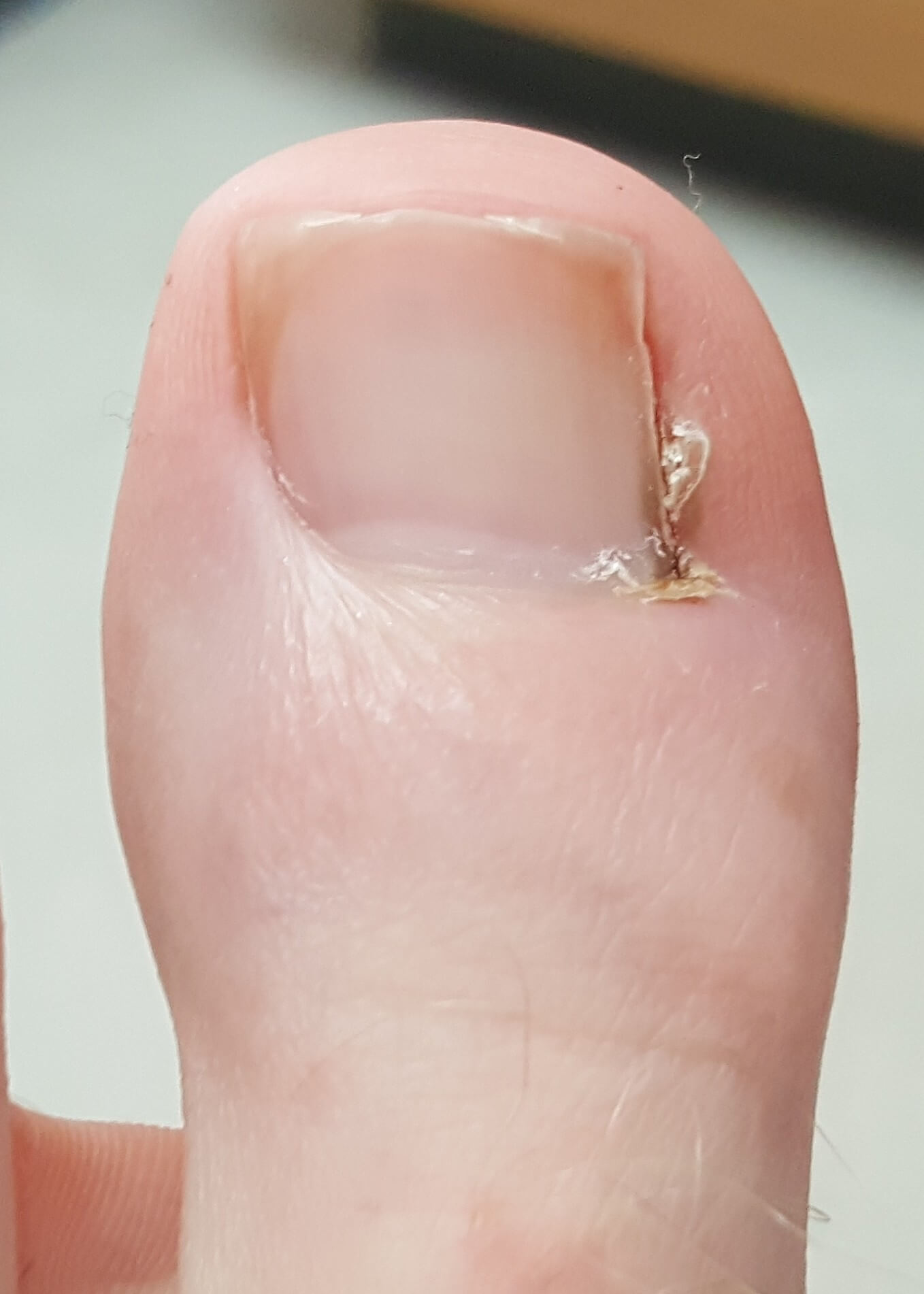 Ingrown ToeNail Treatment In Huntington Beach California