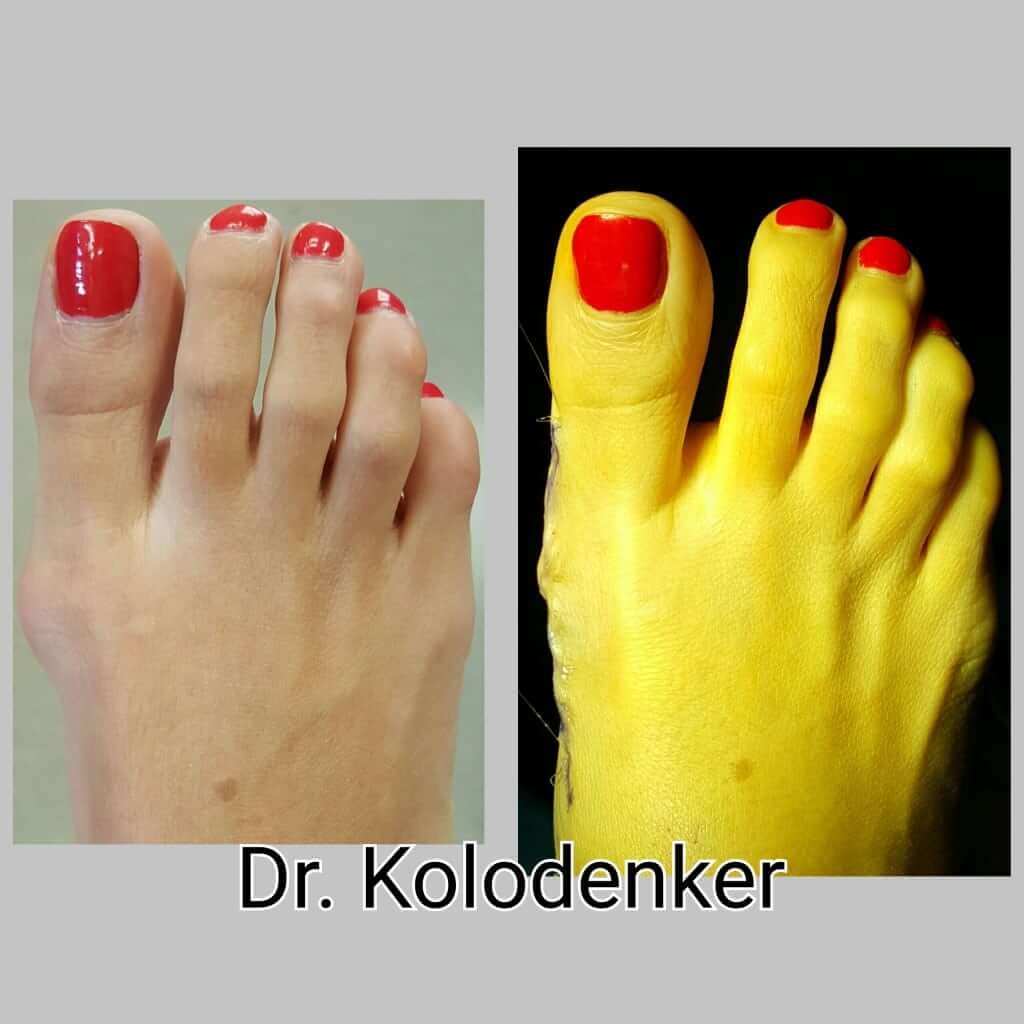 Bunion Surgery OC Podiatry