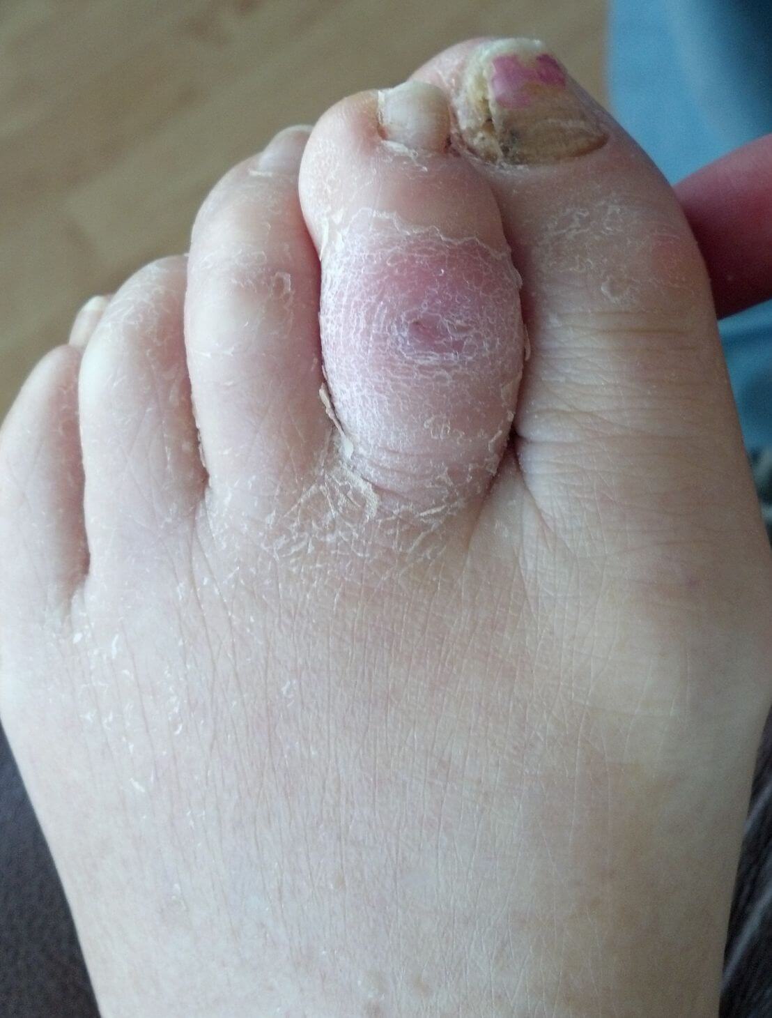 Closed Toe Ulcer OC Podiatry