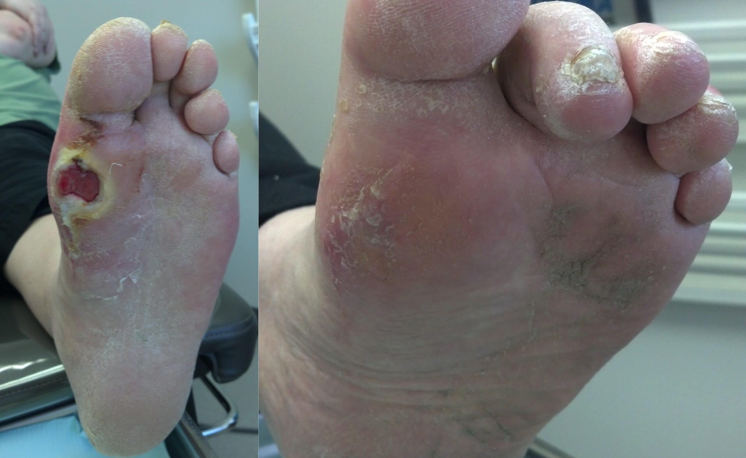 Closed diabetic ulcer after surgical removal of sesamoids
