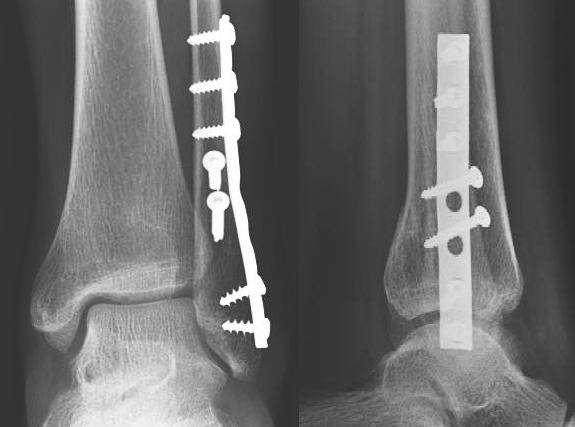 Ankle Fracture Open Reduction and Internal Fixation