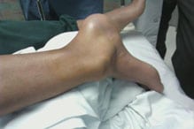 Ankle fracture surgeon orange county