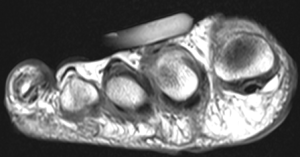 Axial MRI OCD of 2nd Metatarsal bone in Foot
