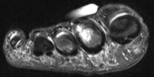 Axial MRI Osteochondral Defect - OCD of 2nd Metatarsal bone in Foot