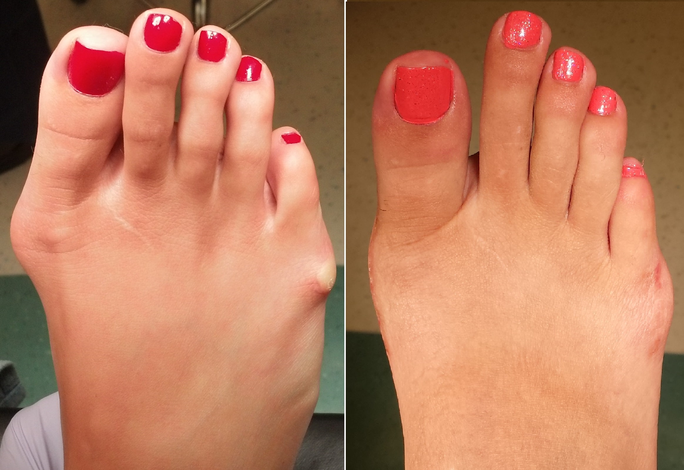 Bunion Pictures Before and After Surgery. 