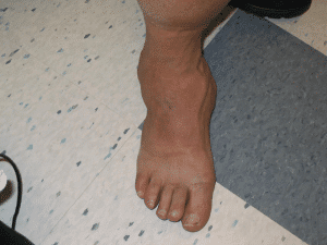 Charcot Foot Doctor in Orange Couty California Irvine