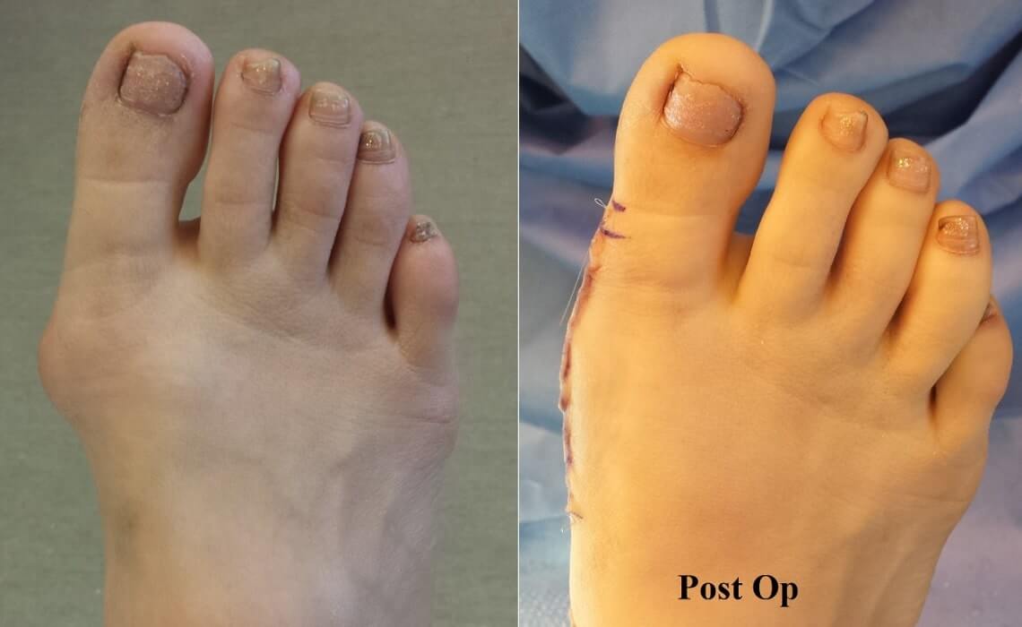 Bunion Surgery OC Podiatry