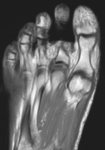 Coronal MRI Osteochondral Defect - OCD of 2nd Metatarsal bone in Foot