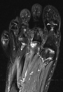 Coronal MRI Osteochondral Lesion - OCD of 2nd Metatarsal bone in Foot