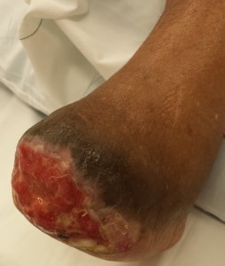 Skin graft surgeon foot ankle Orange County, Mission Viejo, Aliso Viejo, Lake Forest, Laguna Hills, Laguna Beach, Irvine, Newport Beach, Tustin, Orange, Anaheim, Fullerton, Santa Ana, Laguna Niguel, Dana Point. 