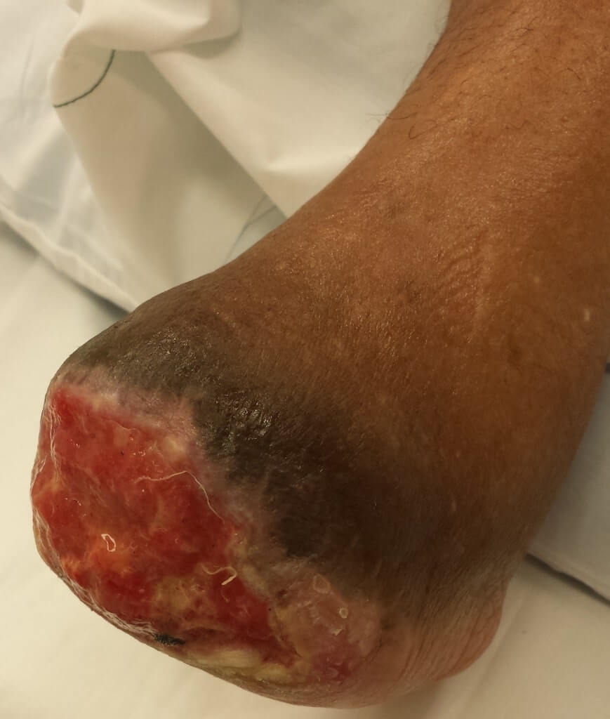 Healing granular midfoot amputation surgery OC Podiatry