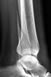 Lateral view of an ankle fracture with displacement in southern california Ankle Surgery
