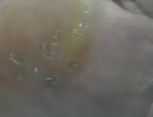 Plantar Warts Treatment Irvine 