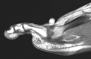 Sagital MRI Osteochondral Defect - OCD of 2nd Metatarsal bone in Foot