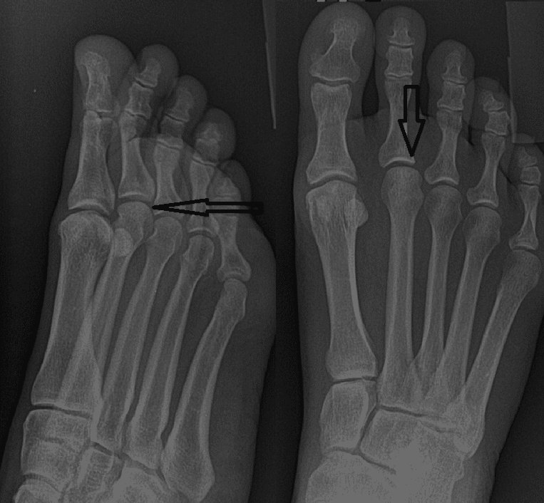 Osteochondral Defect Treatment of the Foot and Ankle