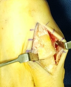 big toe joint pain after surgery cheilectomy orange county 
