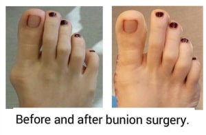 bunion surgery before and after picture - bunion expert in orange county - irvine - newport Beach - mission viejo