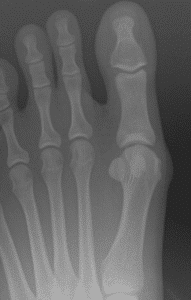 Bunion - Joint is nice and clean with wide space