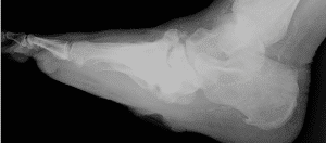 charcot rocker bottom foot and ankle with calcified arteries san  clemente