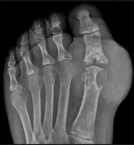 End Stage Gouty Arthritis of the Big Toe Joint