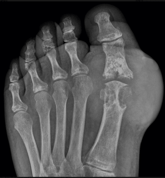 gout xray of the foot big toe joint - OC Podiatry