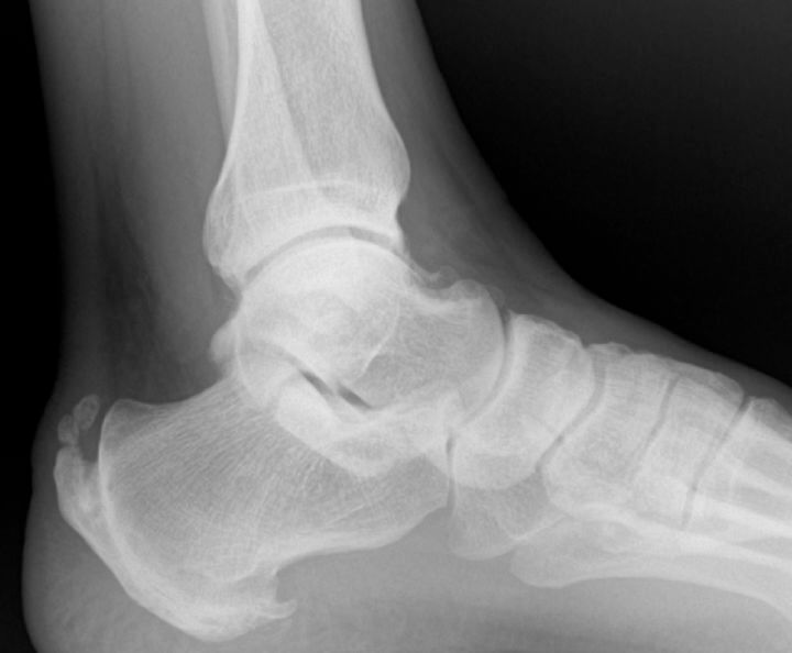 Haglund’s Deformity - OC Podiatry