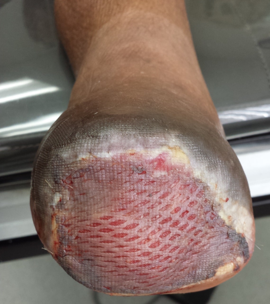 skin graft incorporation 3 days after surgery OC Podiatry