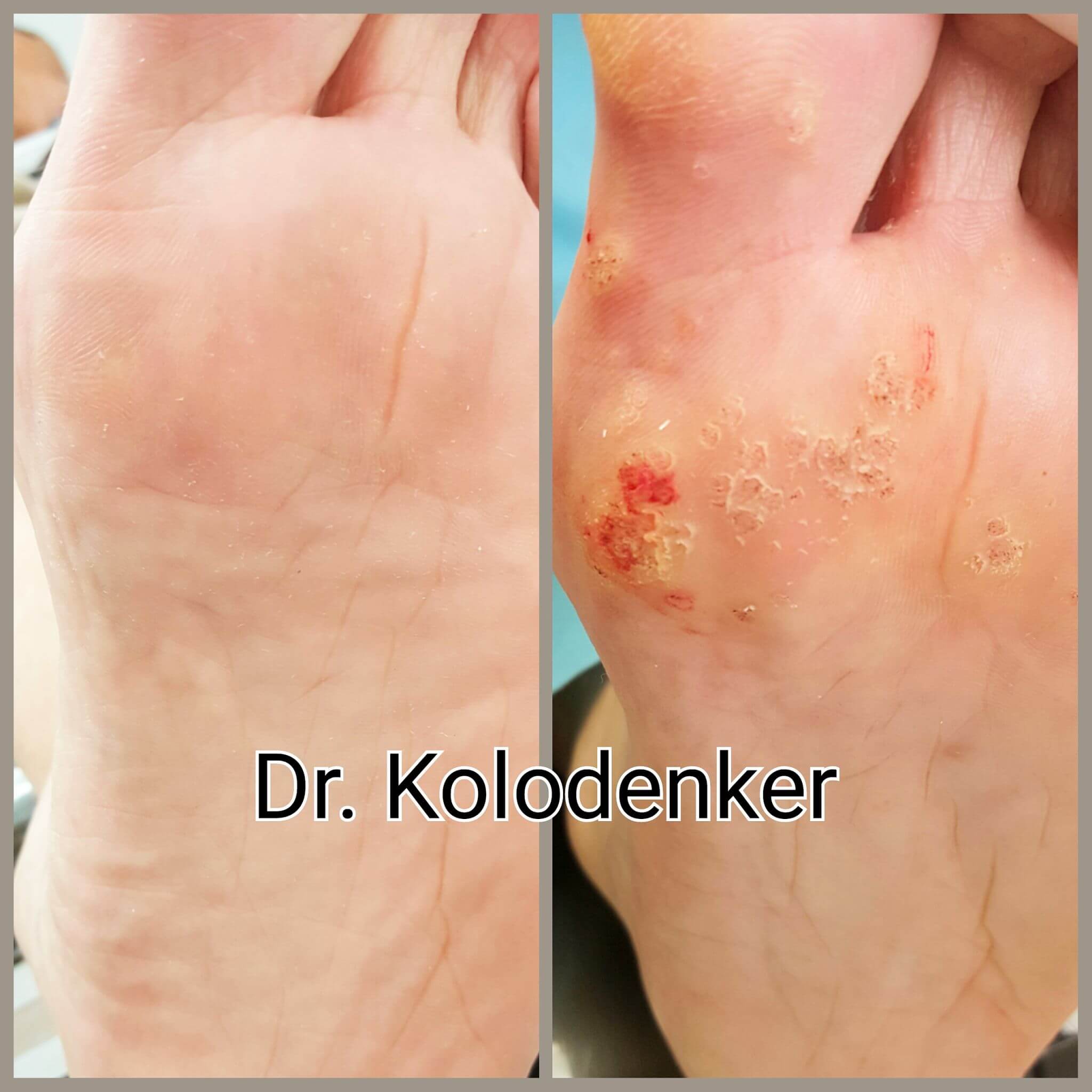 Plantar Warts Treatment in Orange County Irvine, CA OC Podiatry