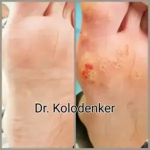 Plantar wart orange county newport laguna hills irvine mission viejo aliso viejo