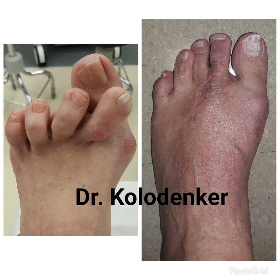 Minimally Invasive Bunion Surgery in Orange County Dr