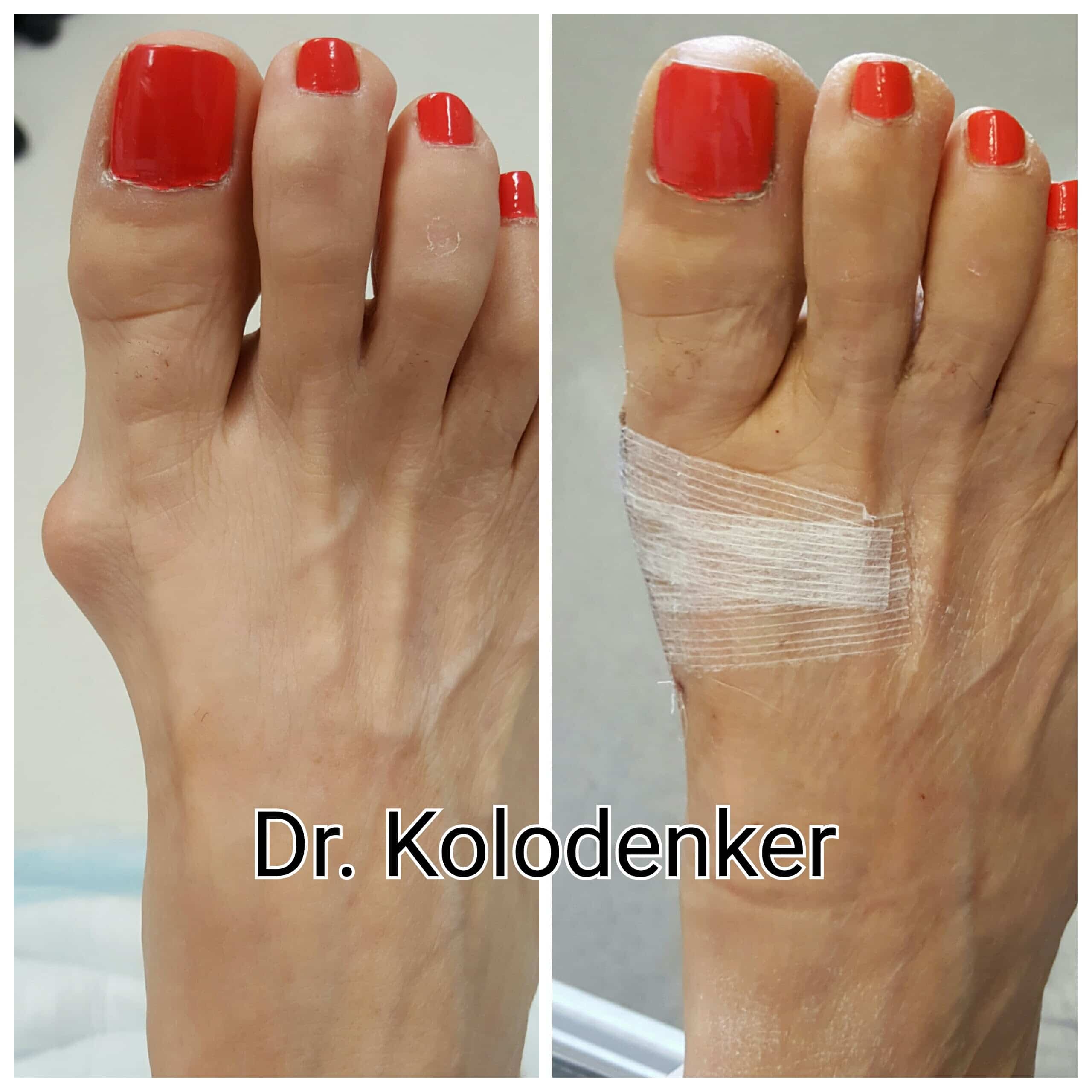 Before and After Bunion Surgery Pictures.