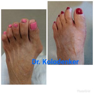 Best Bunion surgeon in Irvine Newport