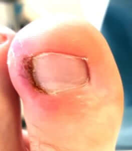 Ingrown Toe Nail Orange County Irvine