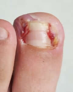 ingrown toenail orange county Irvine HB