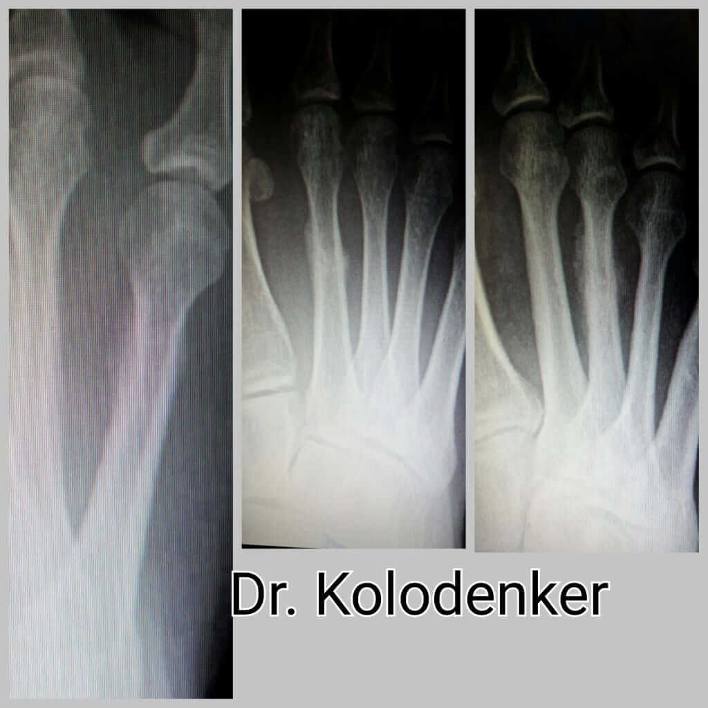 stress fracture in foot stress fracture in foot
