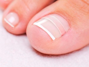 Ingrown Nail Toe Irvine Orange Huntington Beach Same Day