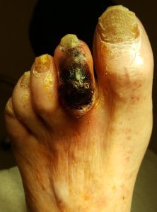 Gangrene of the 2nd toe on the foot Anaheim, Orange, Garden Grove, Santa Ana