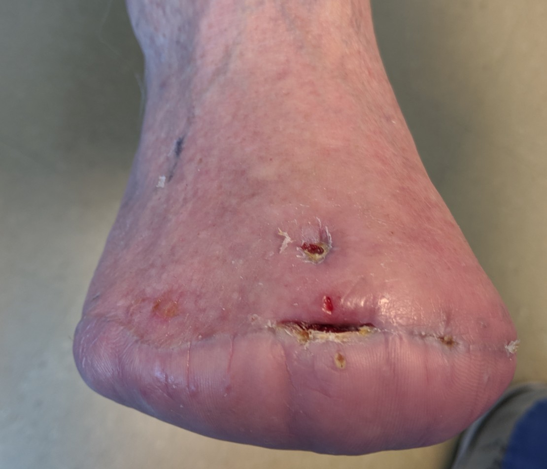 foot amputation - OC Podiatry