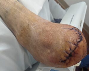 foot amputation transmetatarsal 