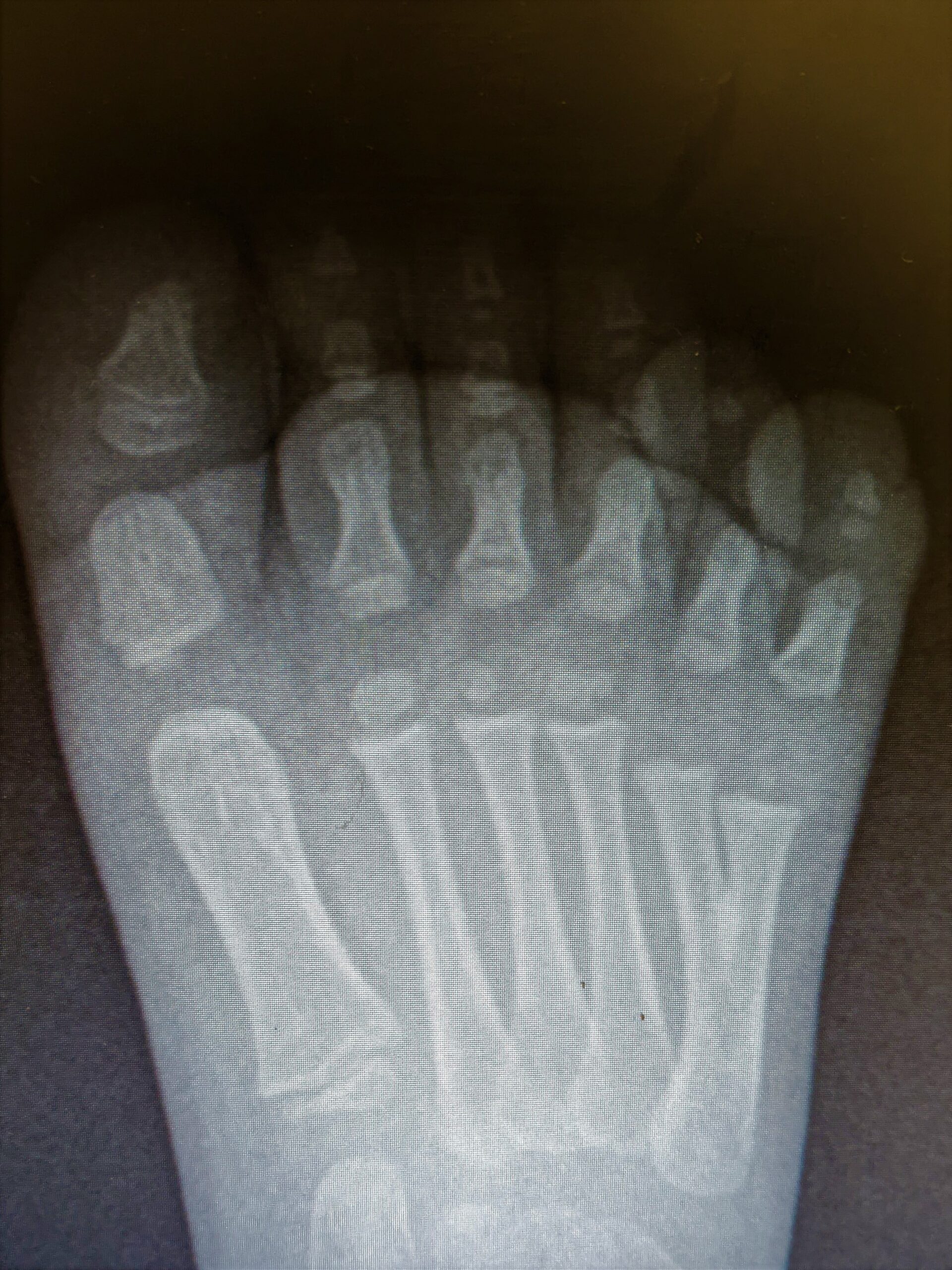 Polydactyly Surgery Orange County